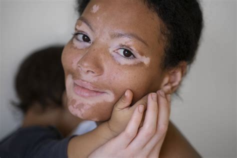 Understanding Vitiligo: Types, Symptoms and Autologous Serum Therapy
