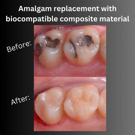 Safe Amalgam Removal at Apex Dental