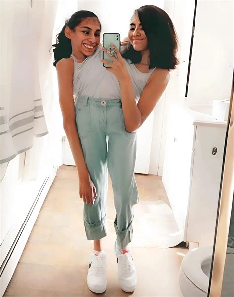 These conjoined twins were joined at the abdomen, but they found