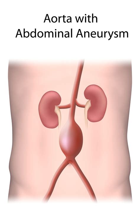 Abdominal Aneurysm Management | Michigan Vascular Center