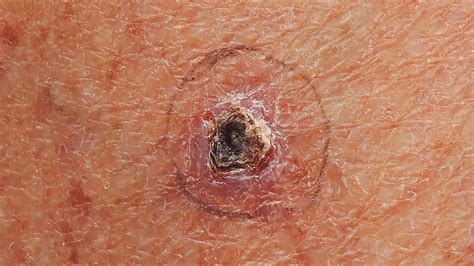 skin cancer basal cell