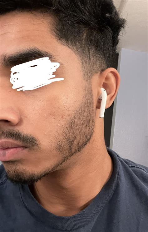 [SKIN CONCERN] Treating Closed Comedones : r/SkincareAddiction