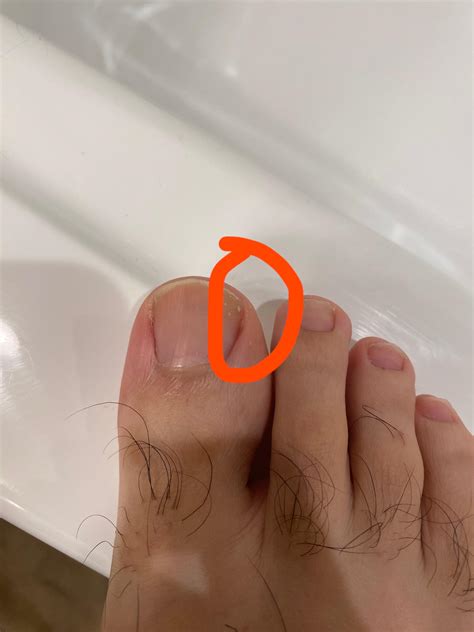 Is this turning into an ingrown toenail? : r/Ingrown_Toenails