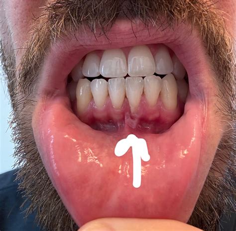 Sore and receding gum, small pocket - gum disease? : r/askdentists