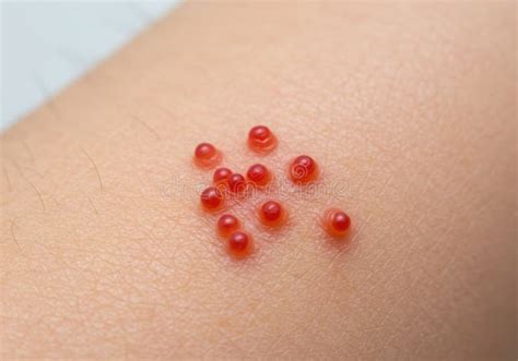cluster  small red bumps  human skin close  stock illustration