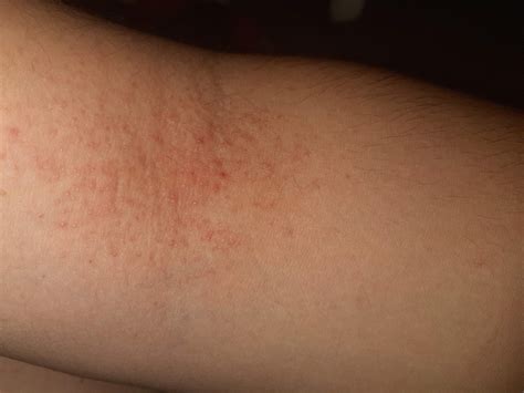 Tipp, was für ein Ausschlag ist das? (Gesundheit und Medizin, Medizin