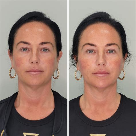 surgical face lift     albert jarman blog