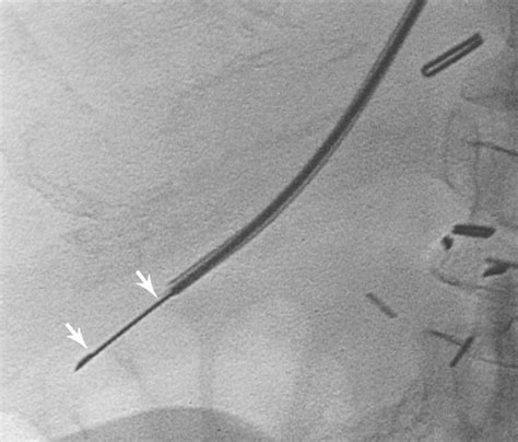 Transjugular Biopsy of the Liver in Pediatric and Adult Patients Using ...