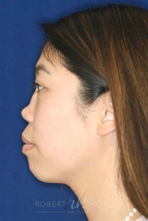 Permanent Non-Surgical Rhinoplasty Case 7 - Dr. Robert Kotler