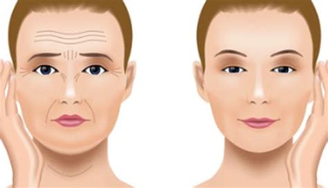 Facelift (Rhytidectomy) - Dr Hamilton