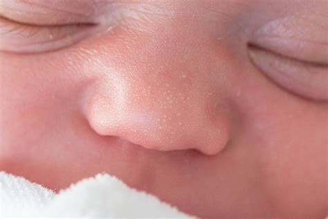 baby milk spots milia     rid    expert