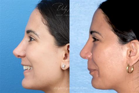 choose  nose tip surgery  full rhinoplasty philip