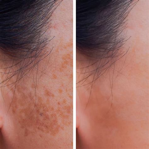 Laser Pigmentation Removal - Medical Spa Services - Santa Rosa