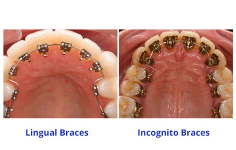 lingual braces singapore introduction  lingual braces