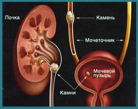Удаление камней из мочевого пузыря