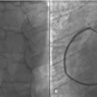 Right coronary angiograms: A -total right coronary artery occlusion, B ...