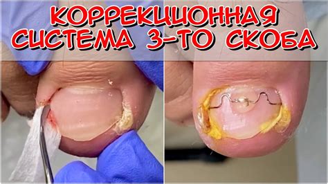Установка 3ТО скобы / Подология / Вросший ноготь / #Nails #педикюр ...