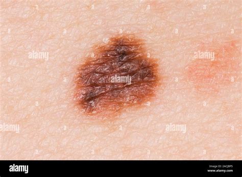 close    atypical naevus mole  spitzoid features