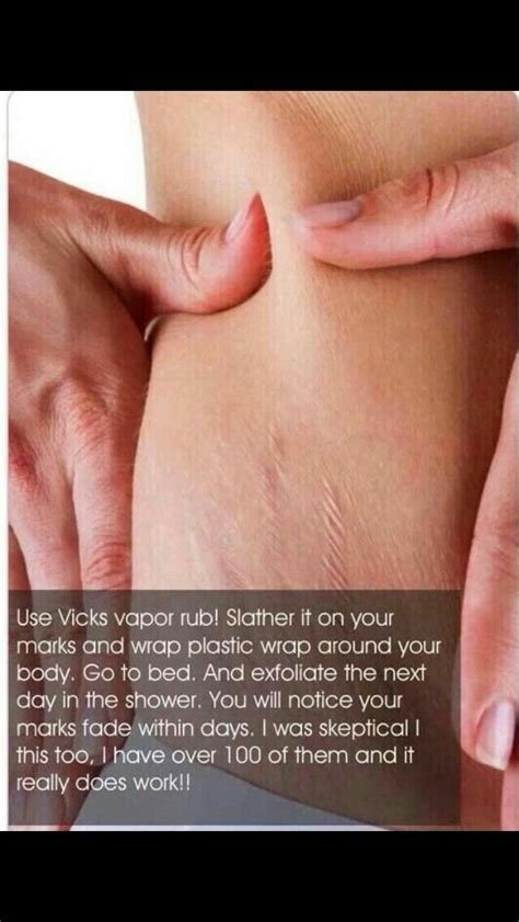 how to get rid of ingrown hairs overnight