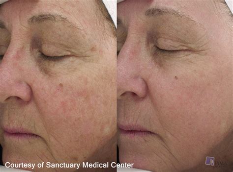 Sun Damage Anti Aging Treatment by Tucson Skin Experts