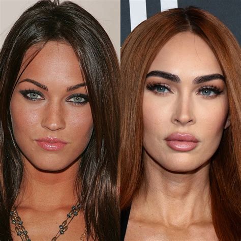 9 Celebrities Before And After Dramatic Lip Fillers | Evie Magazine