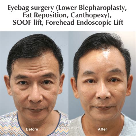 Eye Bag Surgery