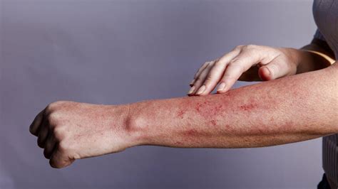 hiv rash types   symptoms     doctor
