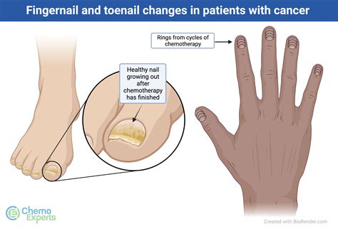 Nail Changes - ChemoExperts