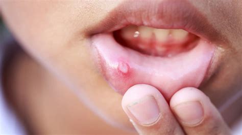 Cáncer de labio: causas, primeros síntomas y prevención
