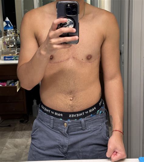 3 months post op vs.6 Months post op : r/TopSurgery