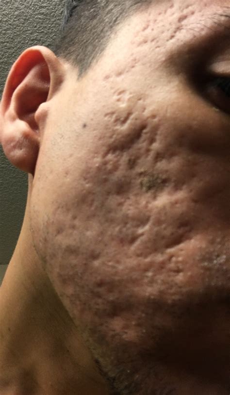 Opinions lasers, filler – Acne Scars – Acne.org Forum