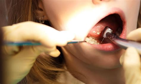 composite filling materials