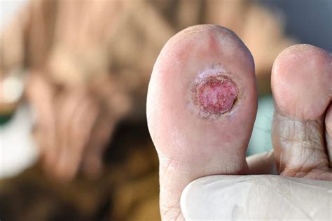 Manage Early-Stage Diabetic Foot Ulcers with Podiatric Care