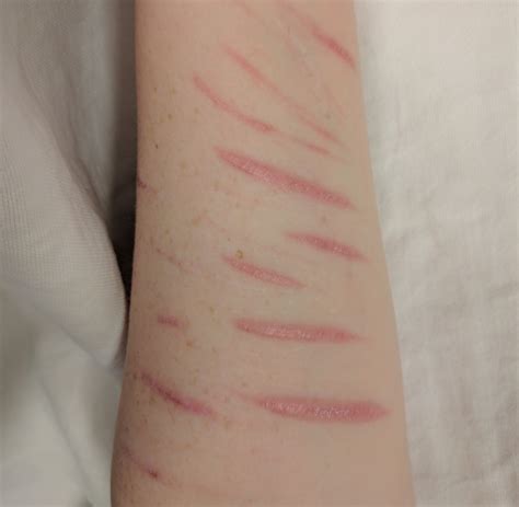 Self Harm Scars Wrist