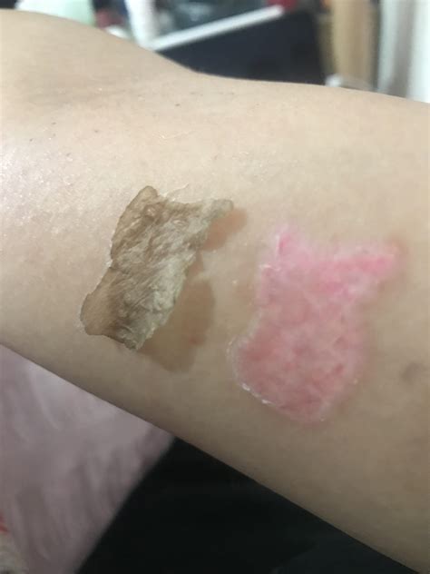 reddit tattoo removal 4