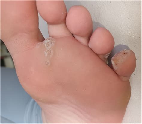 Treatment Of Warts Nhs - Infoupdate.org