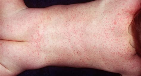 roseola  children ages    babycentre uk