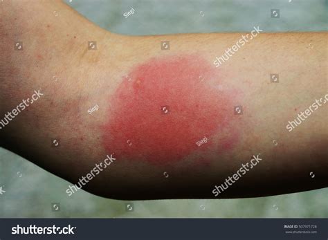 Painful Allergic Reaction Wasp Sting Stock Photo 507971728 | Shutterstock