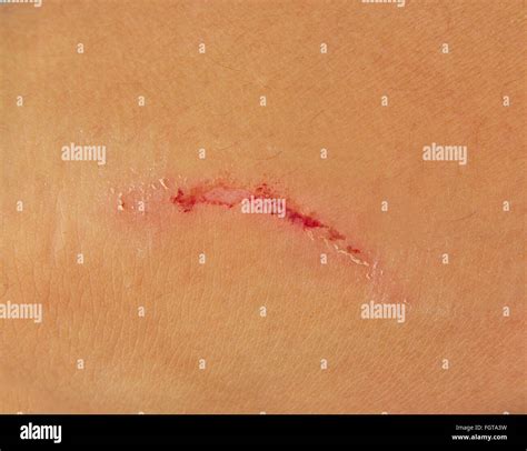 Scratch on a human skin on a white background Stock Photo - Alamy