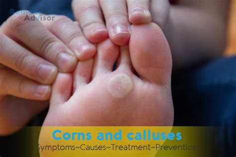 how to fix corns and calluses