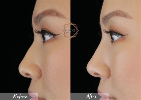 upturned nose rhinoplasty