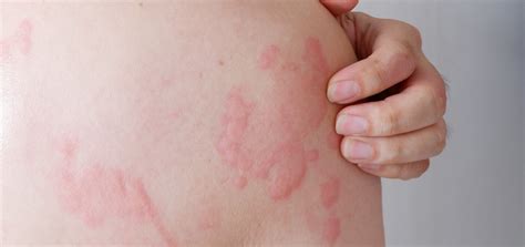 hives skin rashes itchy