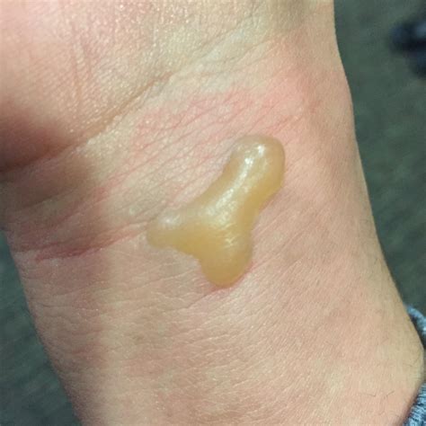 My burn blister : r/mildlypenis