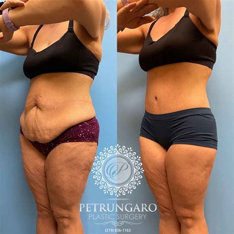Body Lift & Lipo 360 - Petrungaro Plastic Surgery