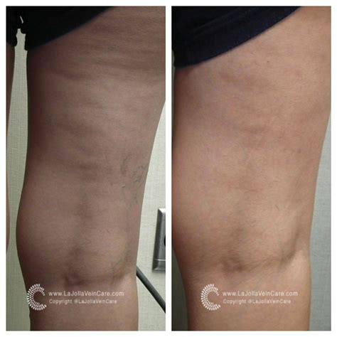 Spider Vein Treatment Before and After