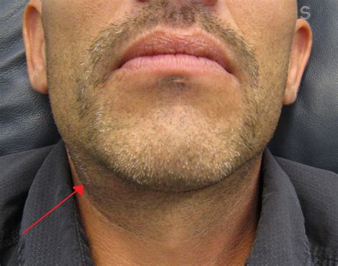 Swollen Submandibular Salivary Glands