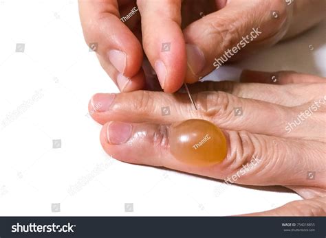 fluid filled blister shutterstock