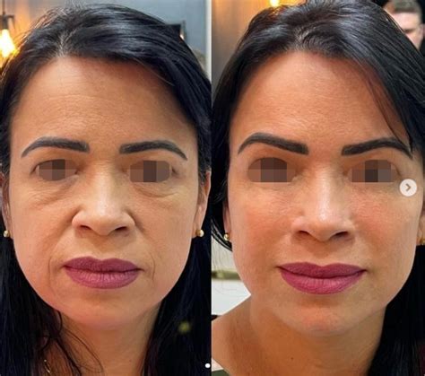 Harmonização Fácial Antes E Depois Feminino - Harmonização Facial Antes e Depois: 30 Resultados