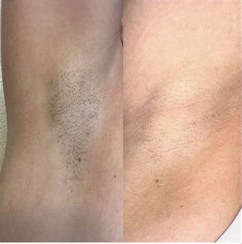 Laser Hair removal (@bocaratonlaser) • Instagram photos and videos