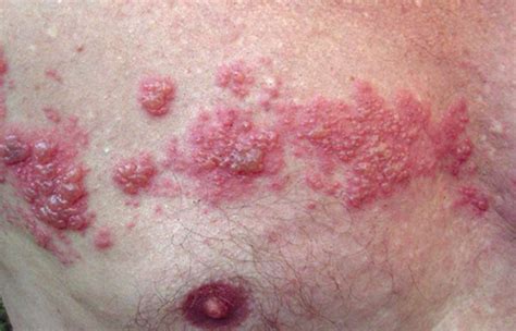 understanding hiv rash symptoms treatment  identification